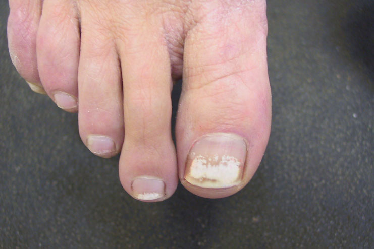 white-discoloration-on-toenails-after-nail-polish-nail-ftempo