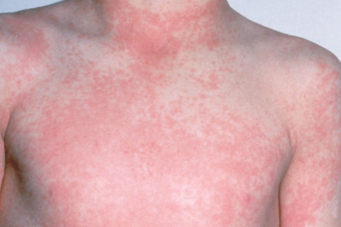 10 Common Skin Rashes in Children | HerGamut