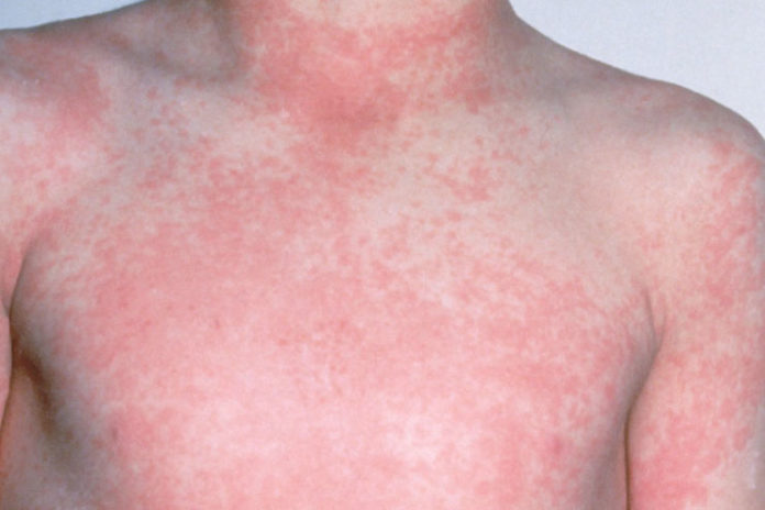 10 Common Skin Rashes In Children HerGamut